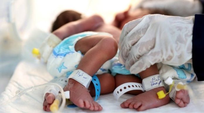 Yemen: Plea to save conjoined twins ‘in critical condition’