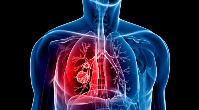 Protein discovery could help with lung cancer treatment and early detection