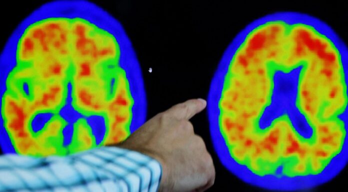 Donanemab found to slow Alzheimer’s and hailed a ‘turning point in fight against disease’