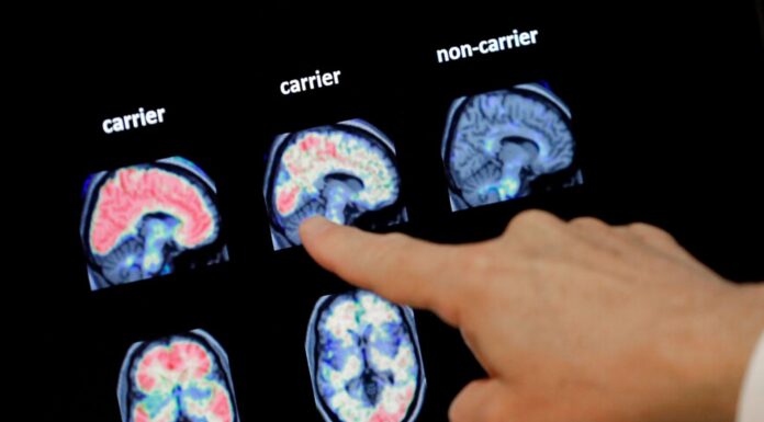 New Alzheimer’s drugs offer hope for bleak diagnosis but remain out of reach in UK
