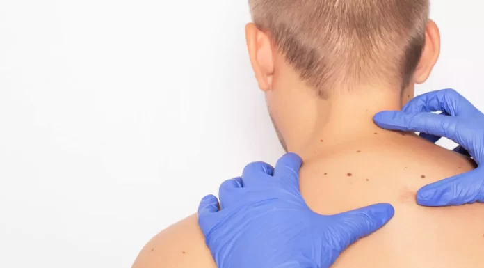 Skin cancer diagnosis delays during COVID lockdowns linked to deaths and €7bn costs in Europe